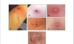 一名男子死于首例致命的阿拉斯加天花病例